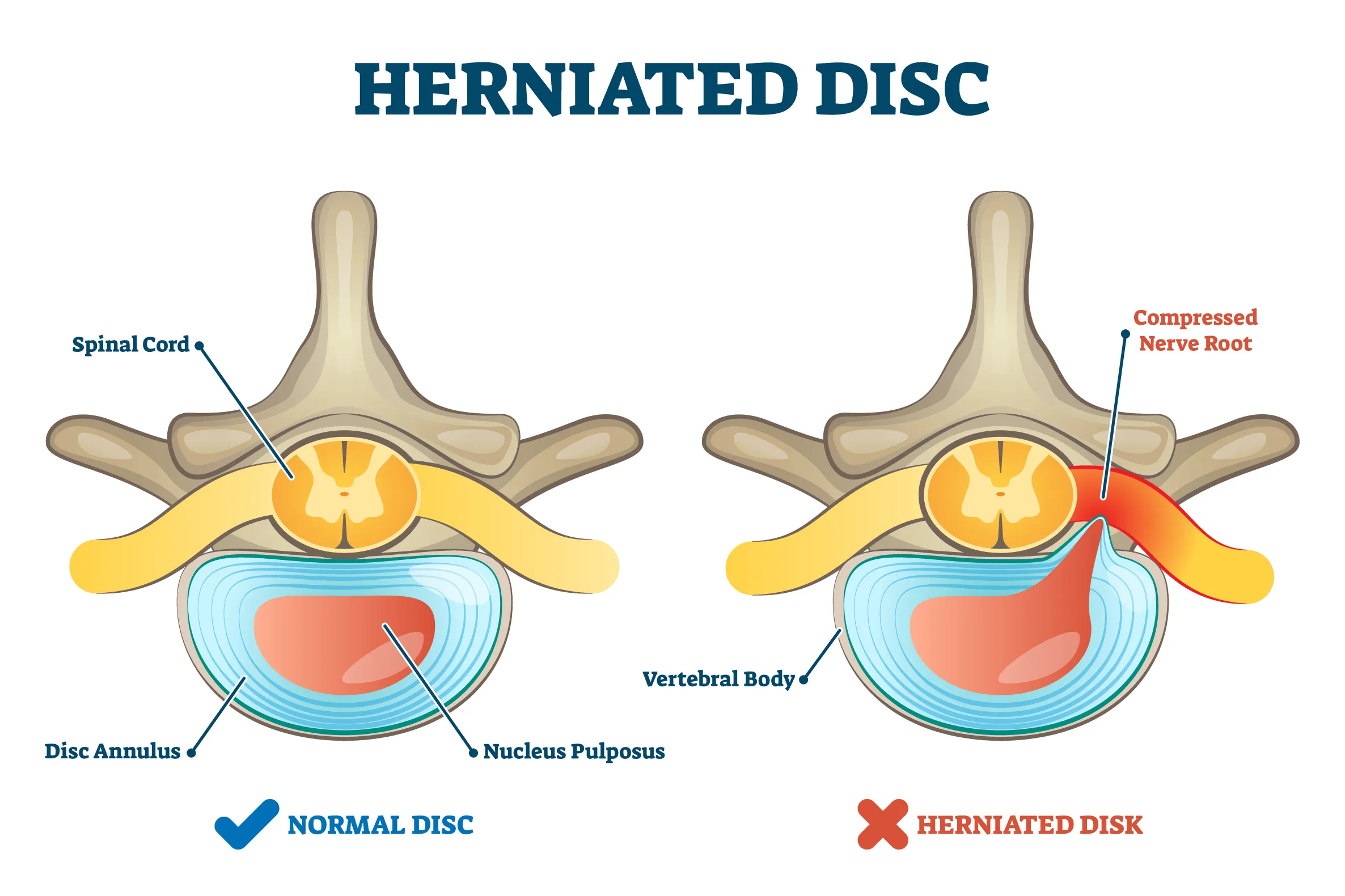 diagram of a normal disc compared to a herniated disc